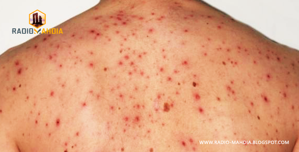 حبوب الظهر : أسبابها ومخاطرها وطريقة العلاج الفعالة لها